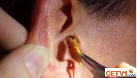 郑州一男子耳朵爬进虫子 医生：应急要“因虫而异”